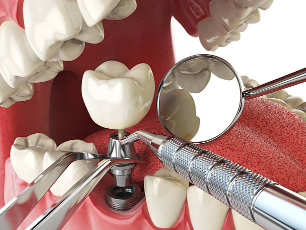 Best Knocked-Out Tooth (Avulsed Tooth) Treatment in Valley Springs, CA